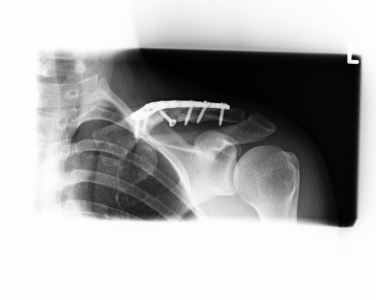 F_CLAVICLE_CR_20221018_181013_1.png